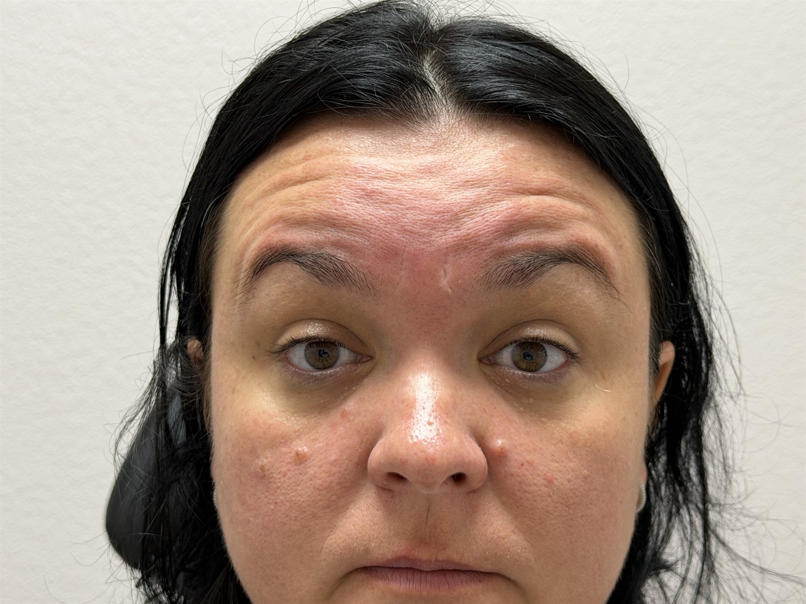 After Botox — Forehead & Frown Lines at Aurora Medical Spa