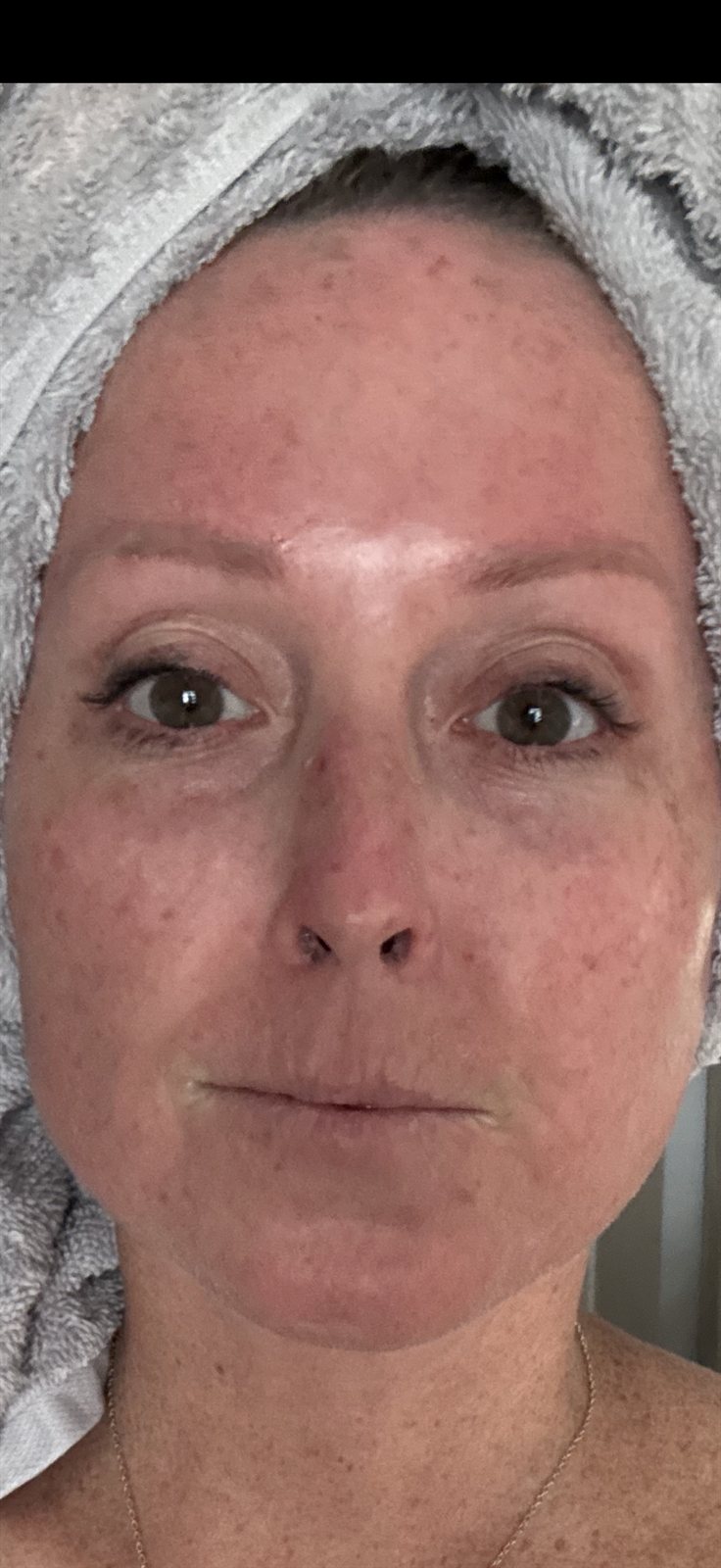 After SkinPen Microneedling — Skin Texture & Tone at Aurora Medical Spa