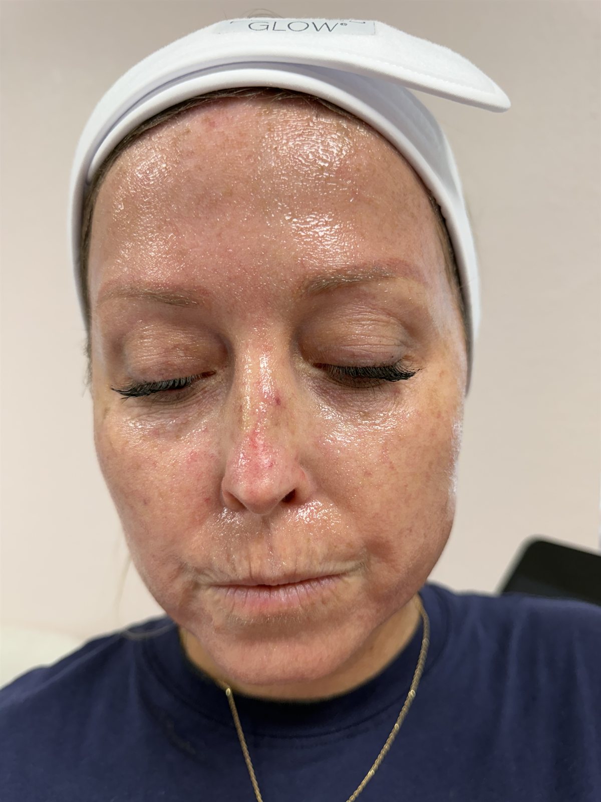 Before SkinPen Microneedling — Skin Texture & Tone at Aurora Medical Spa