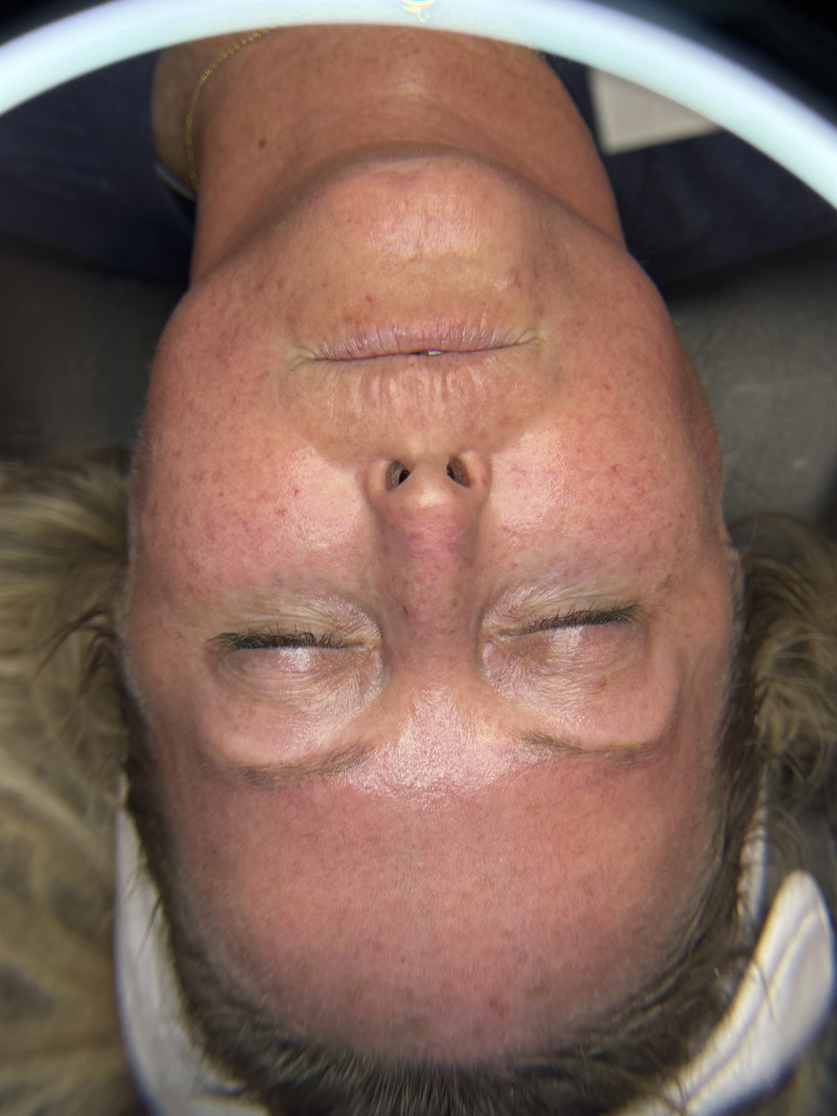 After DiamondGlow — Skin Clarity & Glow at Aurora Medical Spa