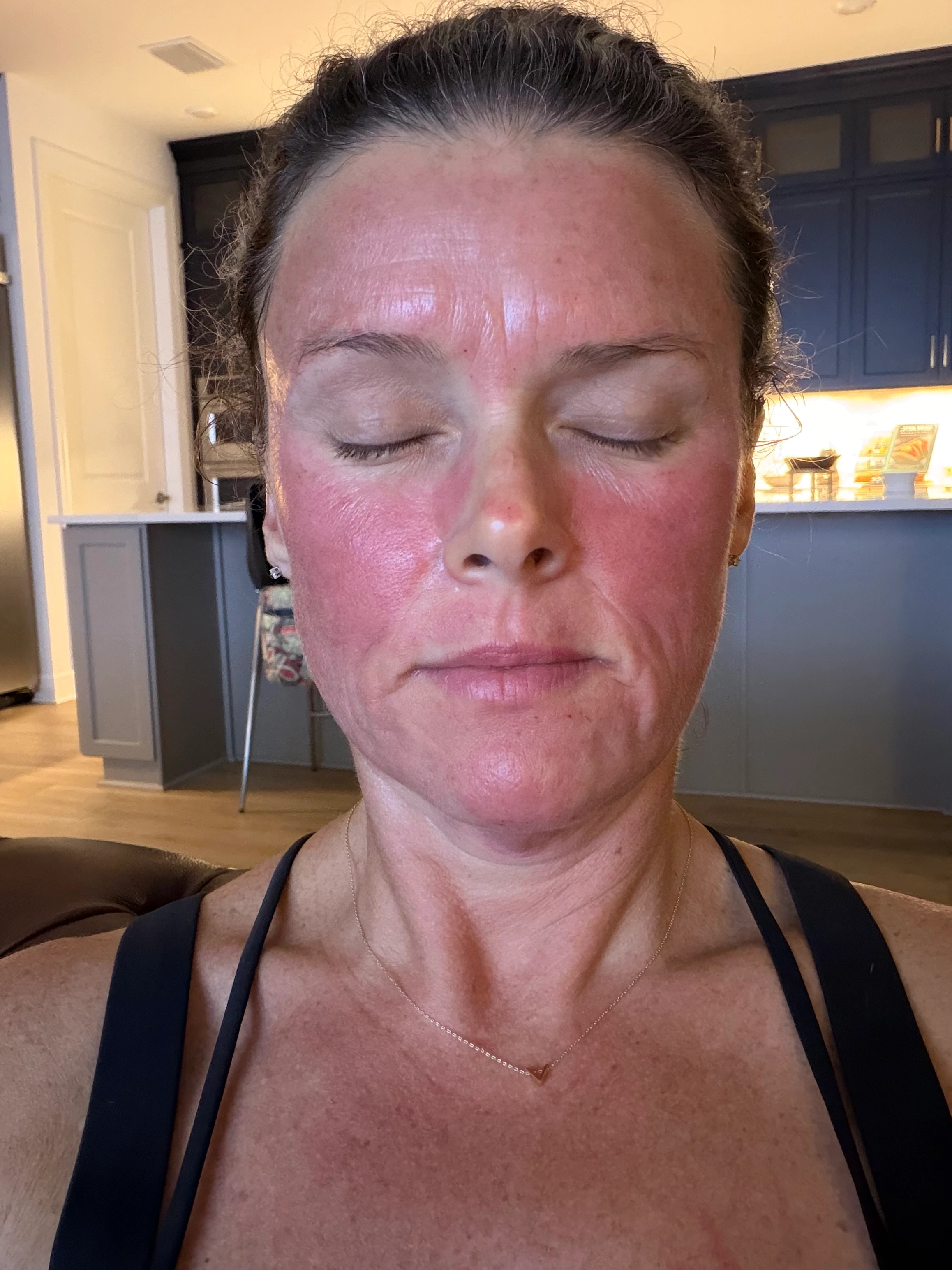 Before SkinPen Microneedling — Skin Texture & Tone at Aurora Medical Spa