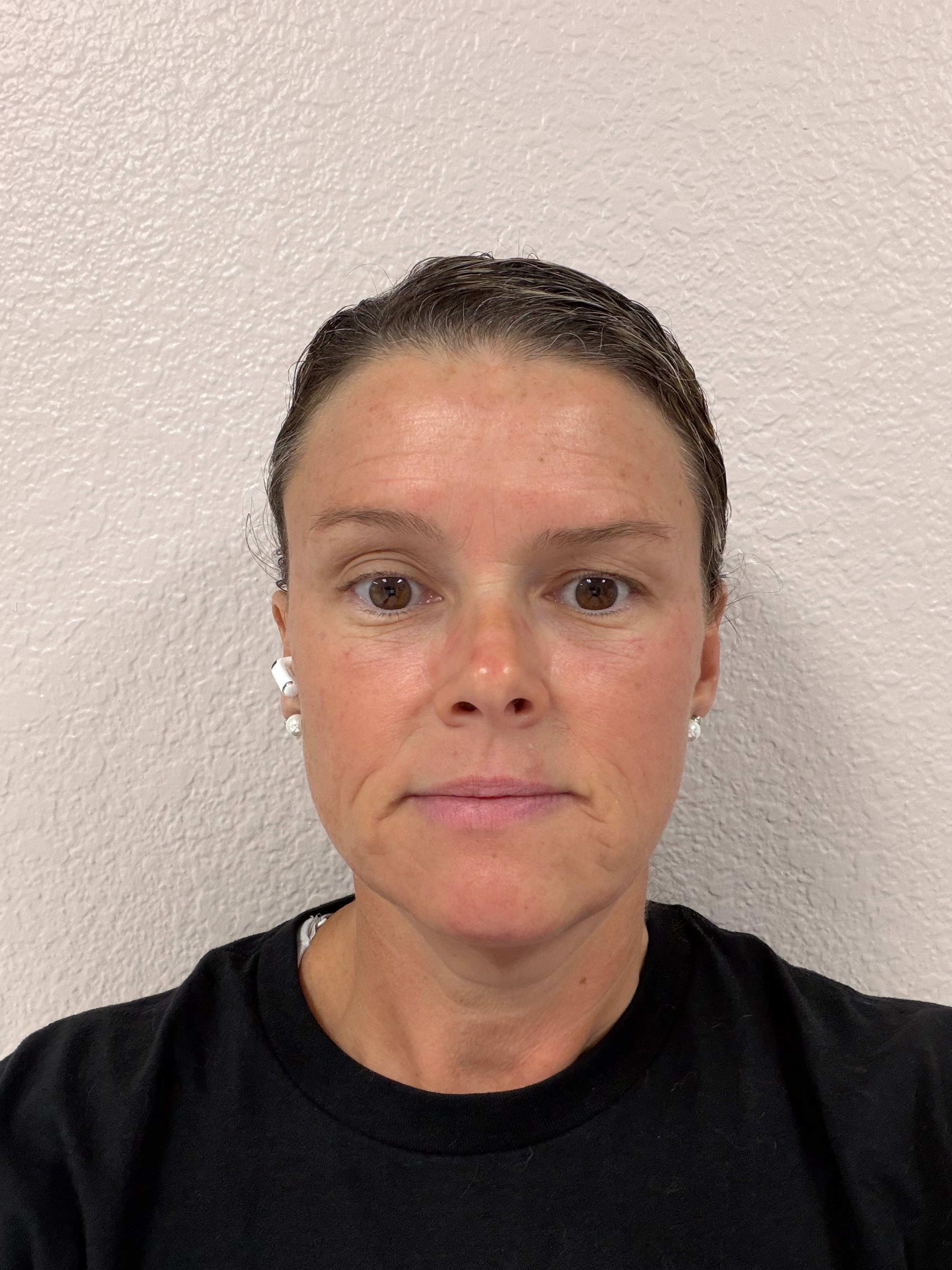 After SkinPen Microneedling — Skin Texture & Tone at Aurora Medical Spa