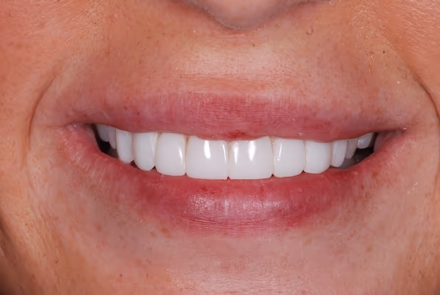 Close-up of a person's smile showing clean, white teeth and natural lips with some freckles and skin texture.