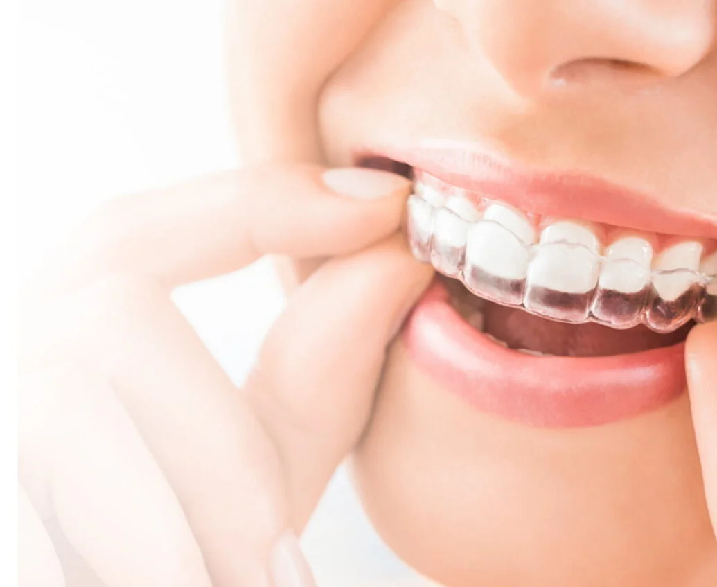 Close-up of a person inserting a clear dental aligner over their upper teeth.