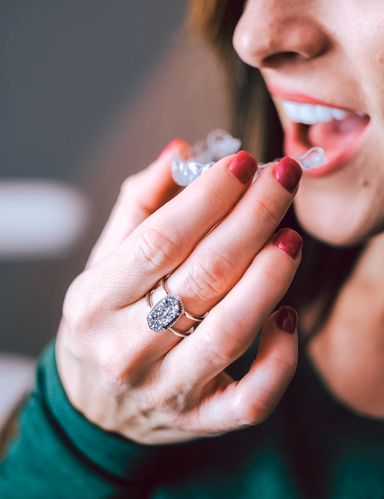 Invisalign planning at Forest Family Dentistry