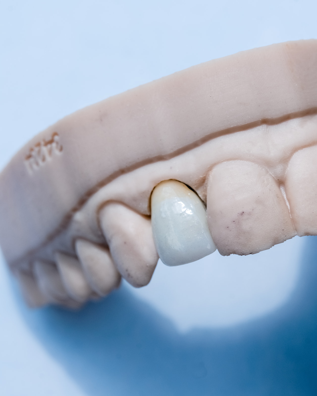 Custom dental crown and bridge care