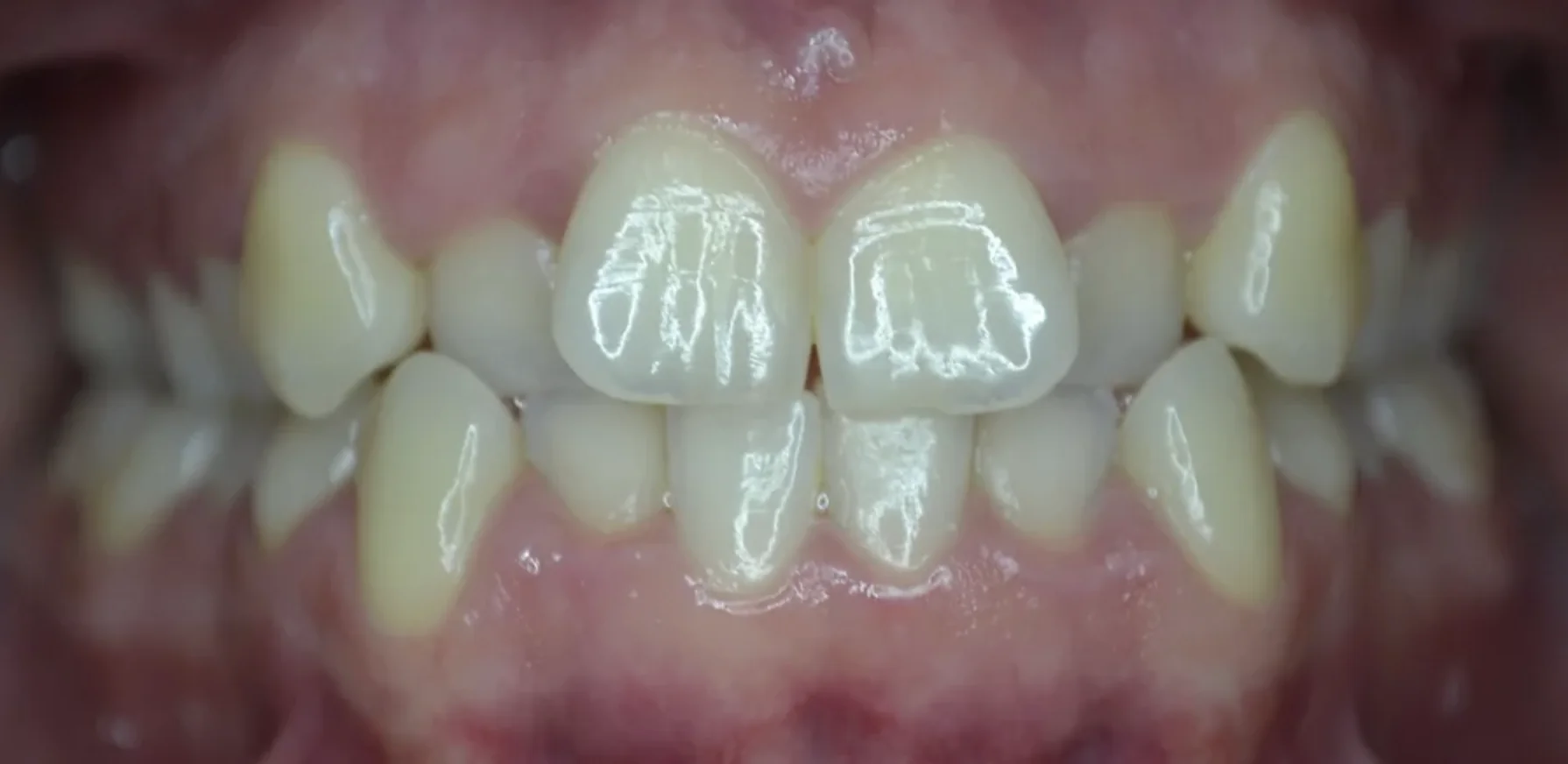 Brittani before Invisalign treatment