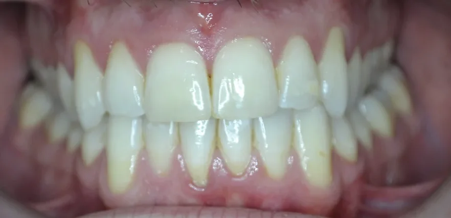 Gage after Invisalign treatment