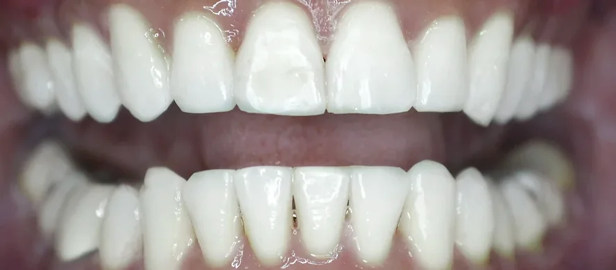 Evan after Invisalign treatment