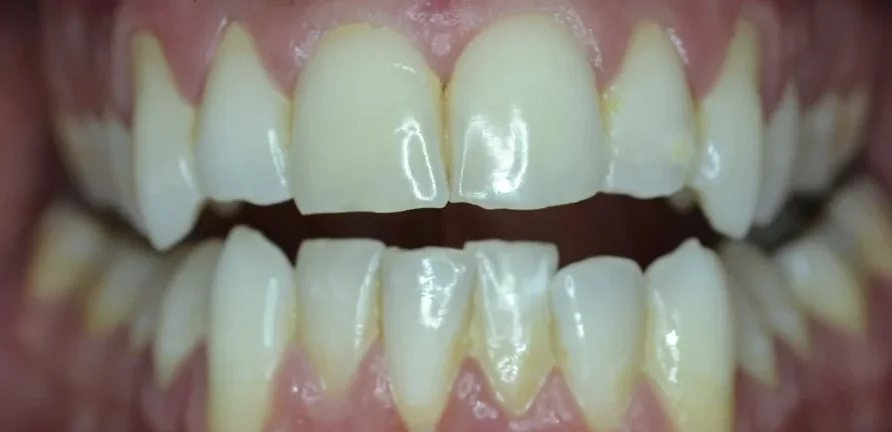 Gage before Invisalign treatment