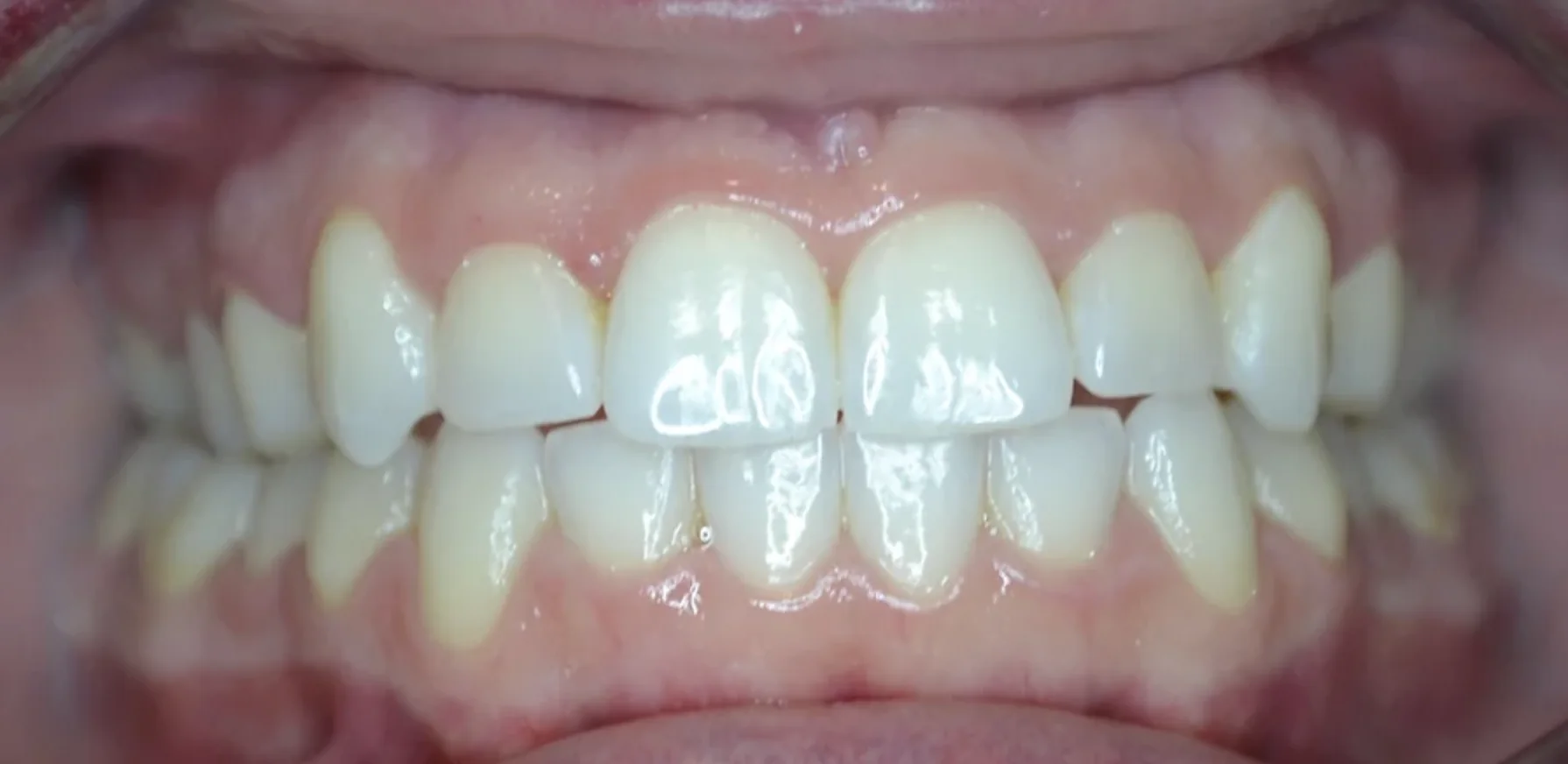 Brittani after Invisalign treatment
