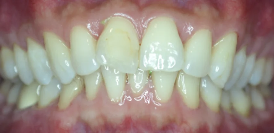 Evan before Invisalign treatment