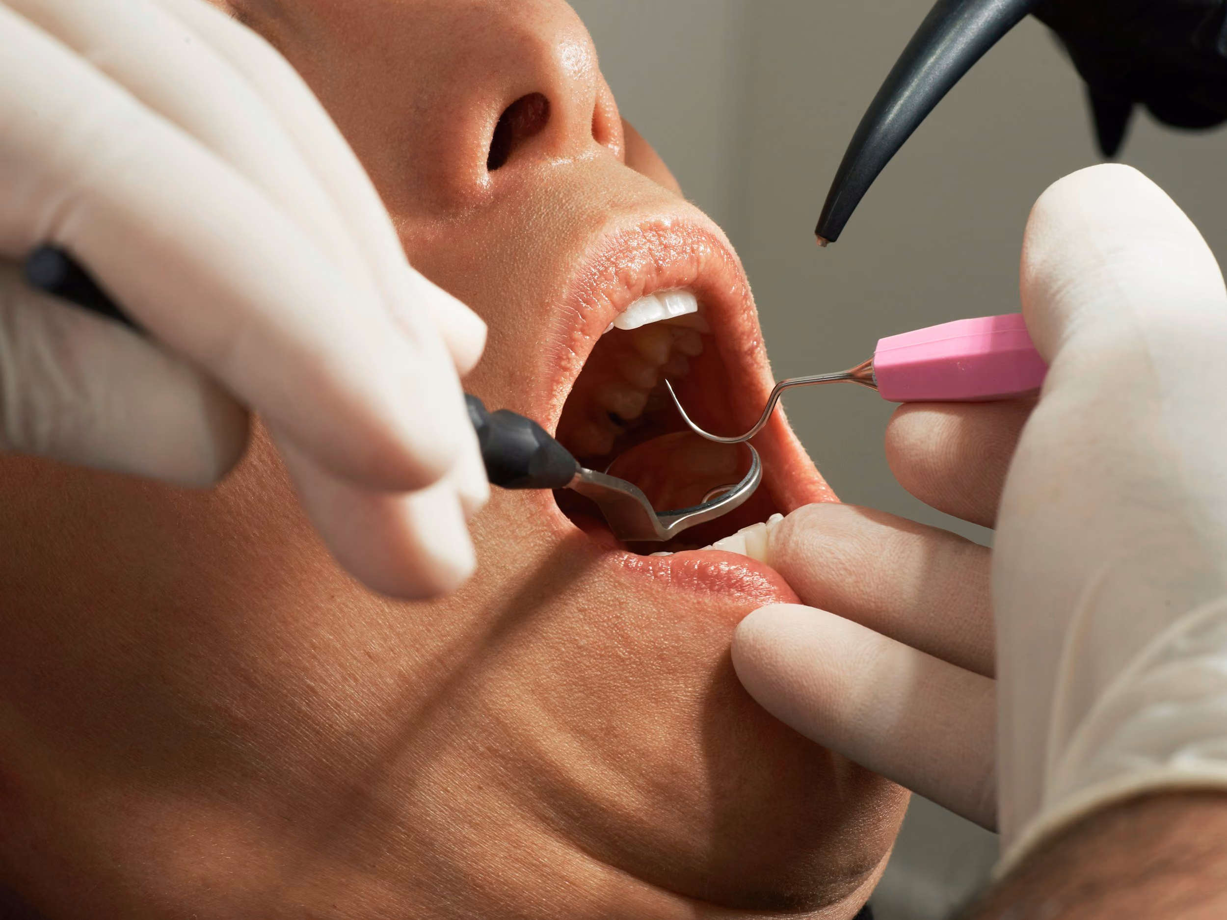 Close-up of a dental exam with a person’s mouth open and dentist using tools and wearing gloves.