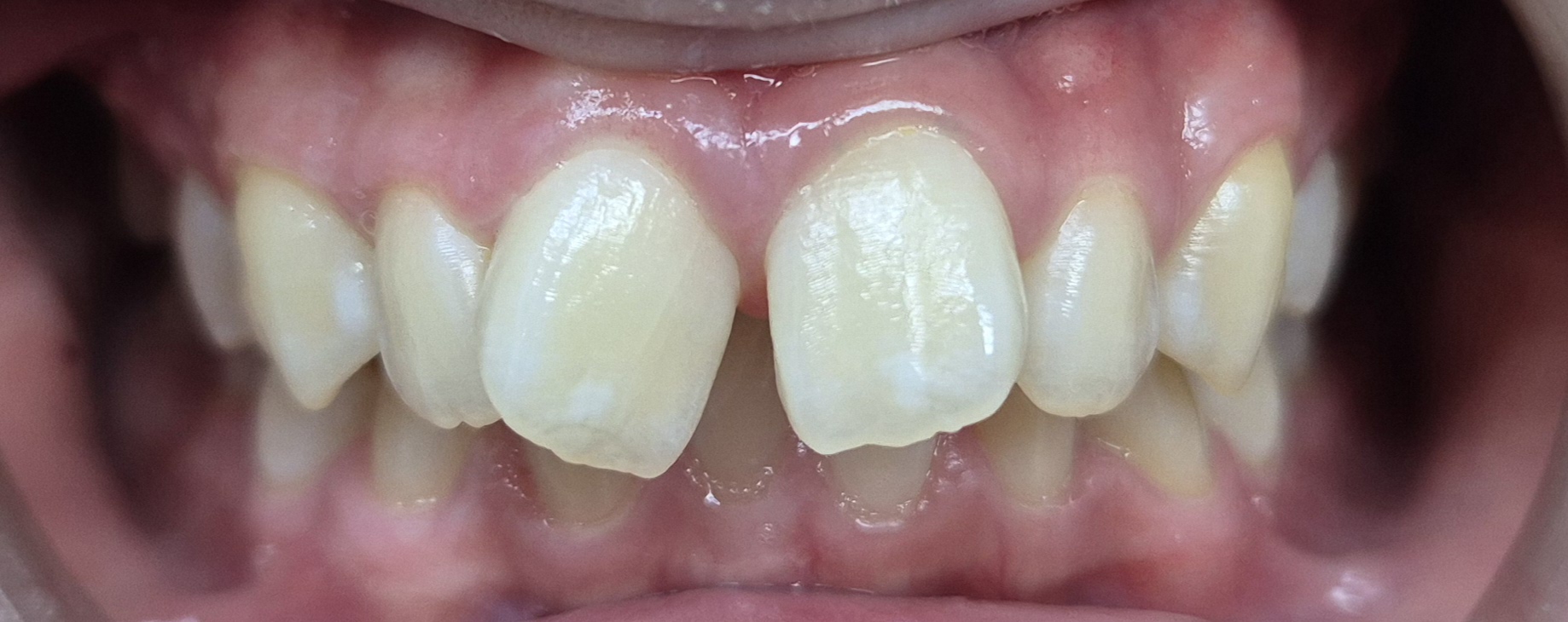Case 1 mild crowding before Invisalign treatment