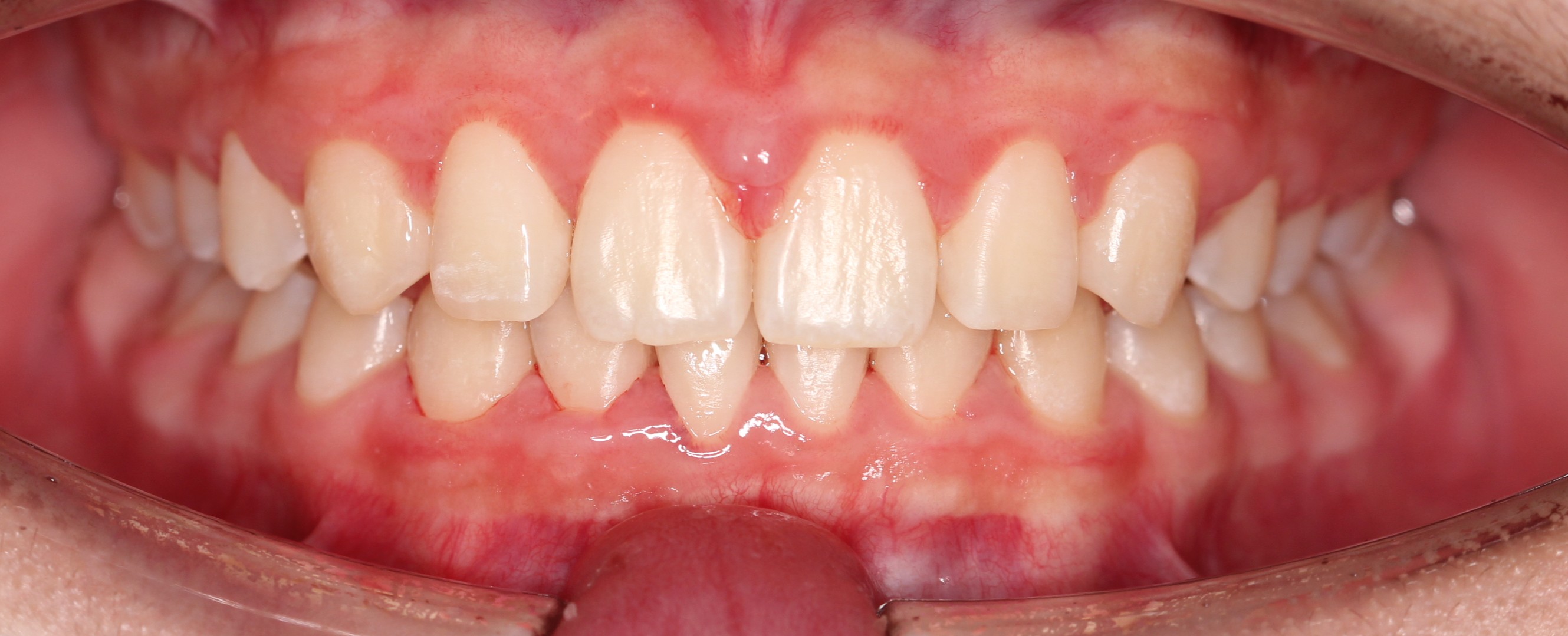 Case 2 gapped smile after Angel Aligner treatment