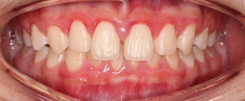 Case 2 gapped smile before Angel Aligner treatment