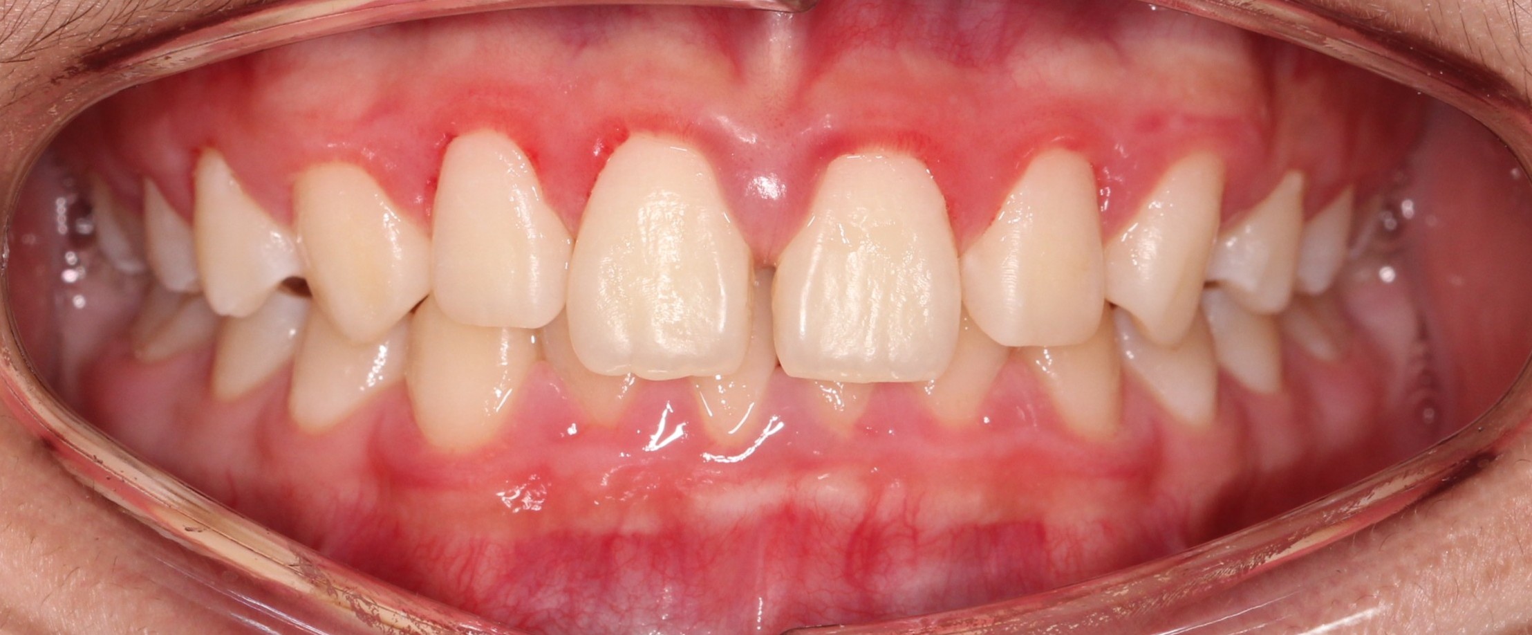 Case 2 gapped smile before Angel Aligner treatment
