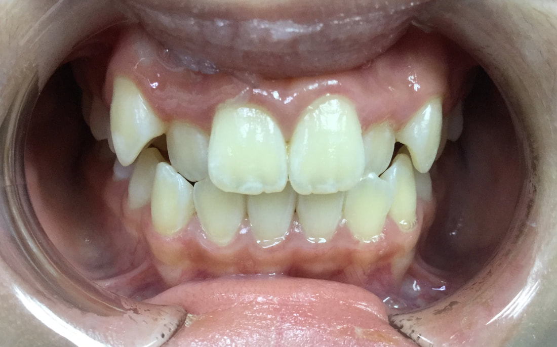 Before treatment: crowded teeth with a high pointed canine
