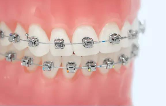 Model of teeth fitted with metal braces and archwires