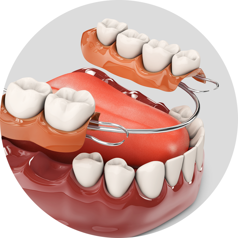 Illustration of a partial denture