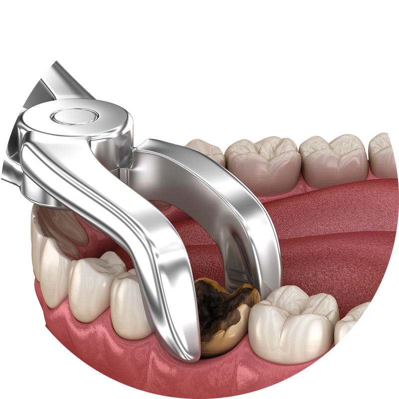 Illustration of forceps extracting a decayed tooth