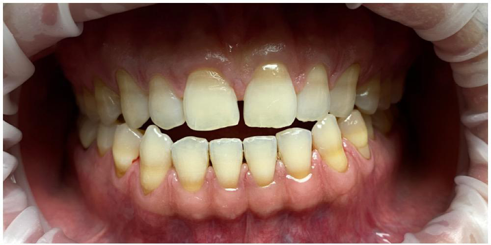 Before whitening: yellow-stained teeth