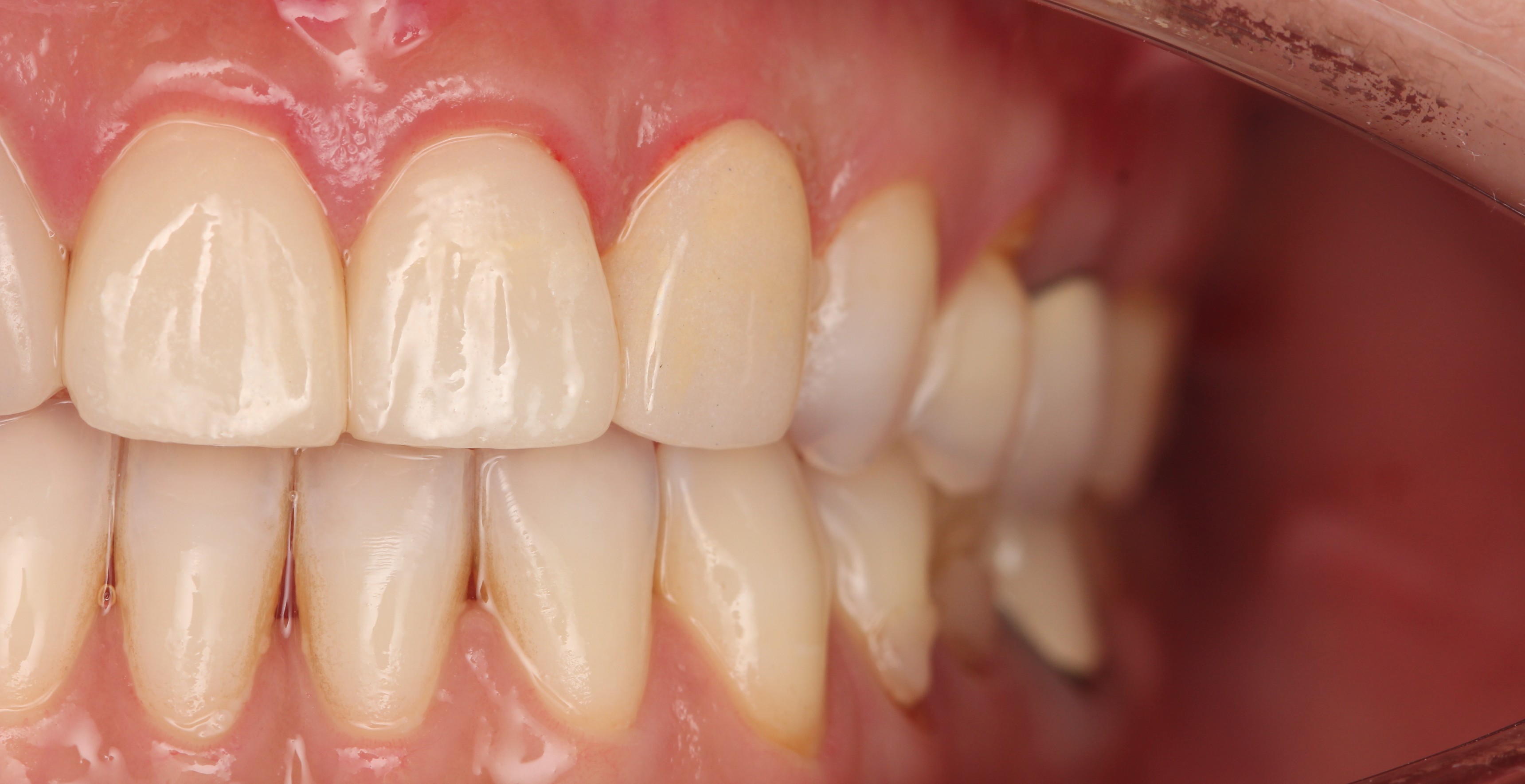 After treatment: gap closed and teeth evenly spaced