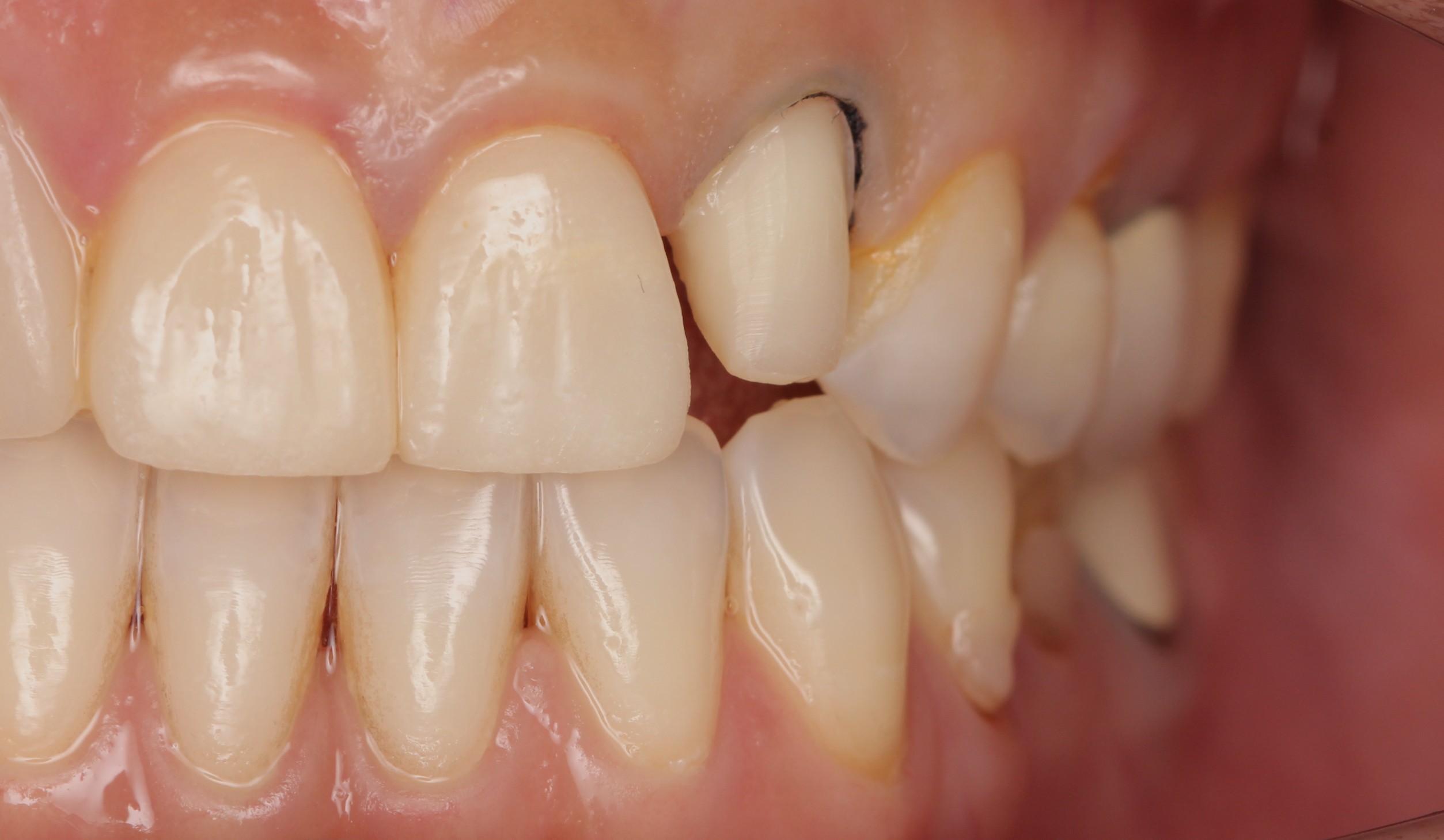 Before treatment: gap between the upper front teeth and neighbouring tooth
