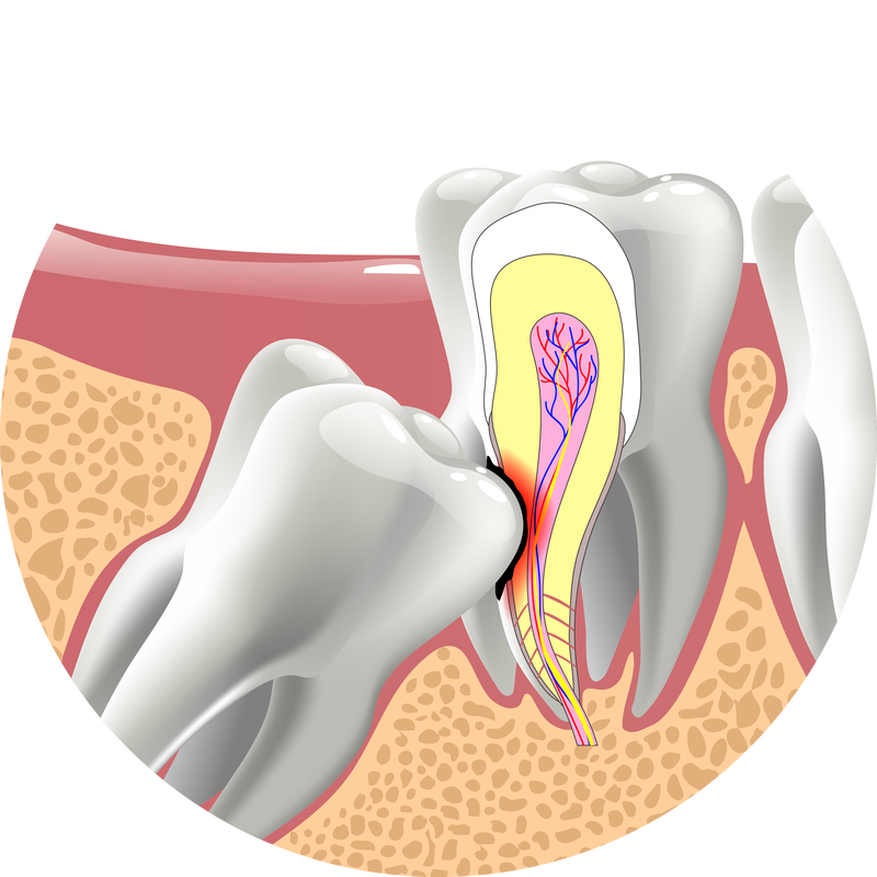 Illustration of an impacted wisdom tooth pressing against the neighbouring tooth
