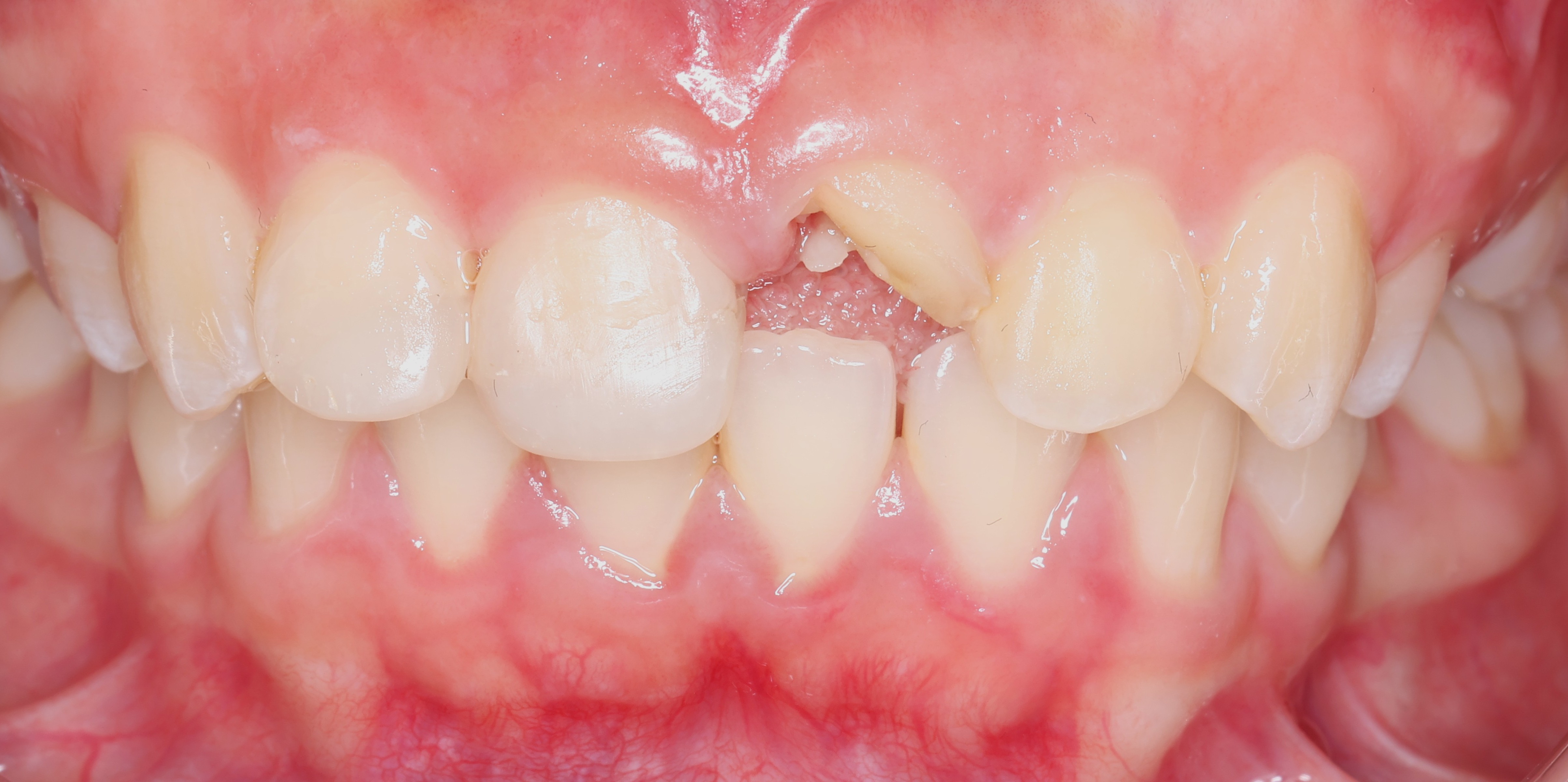 Case 1 before: upper front tooth lost to trauma, leaving a gap with a small tooth fragment