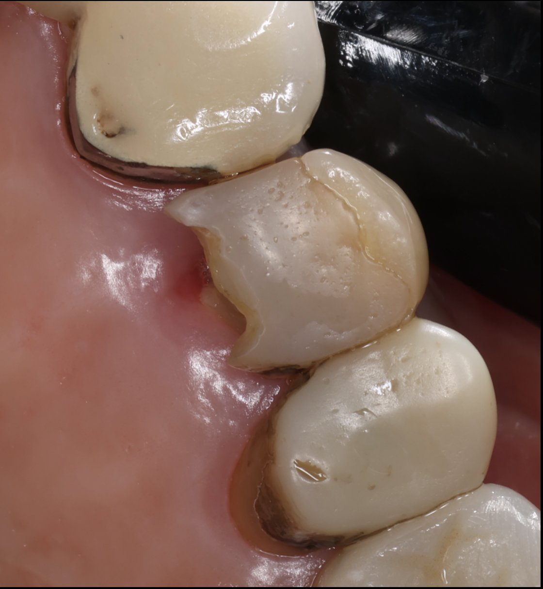Case 3 before: broken, worn-down tooth next to neighbouring crowns