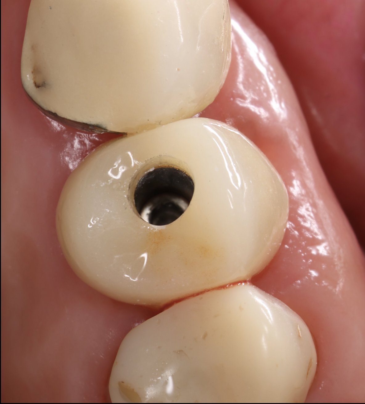 Case 3 after: new implant crown with screw access hole, between neighbouring teeth