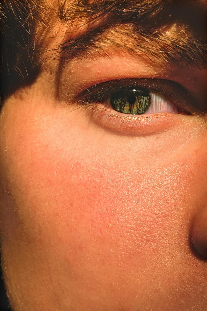 Anti-wrinkle injection treatment at Iris Clinic