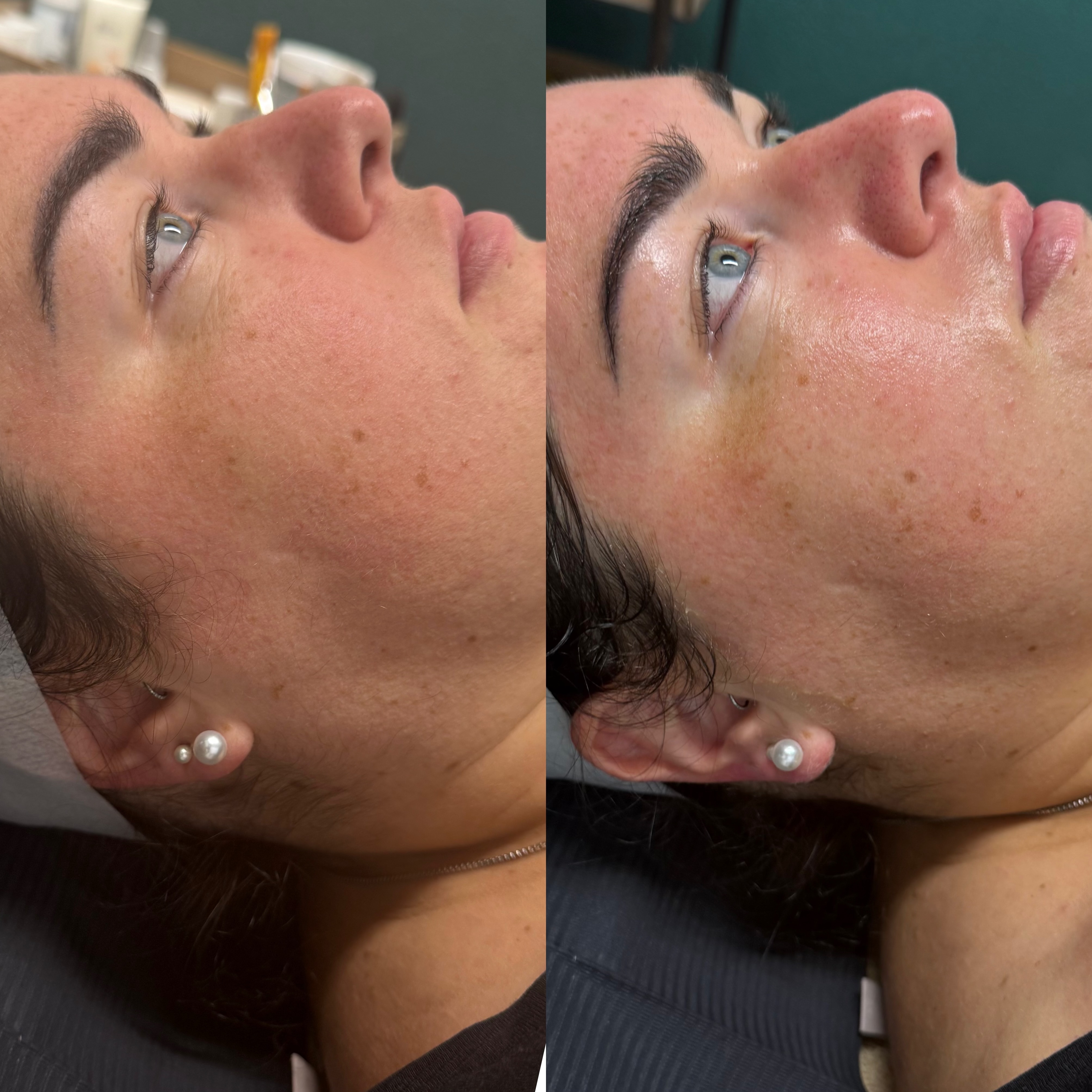 Microneedling Behandlung bei Marino Cosmetics