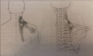 points gachette au niveau des cervicales