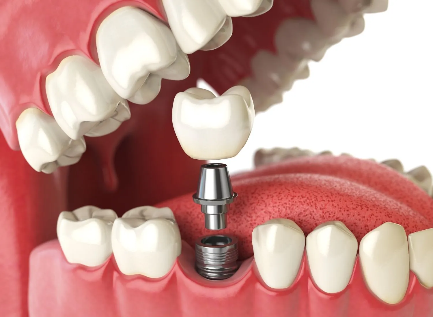 3D illustration of a dental implant being placed in the lower jaw with surrounding teeth and gums visible.