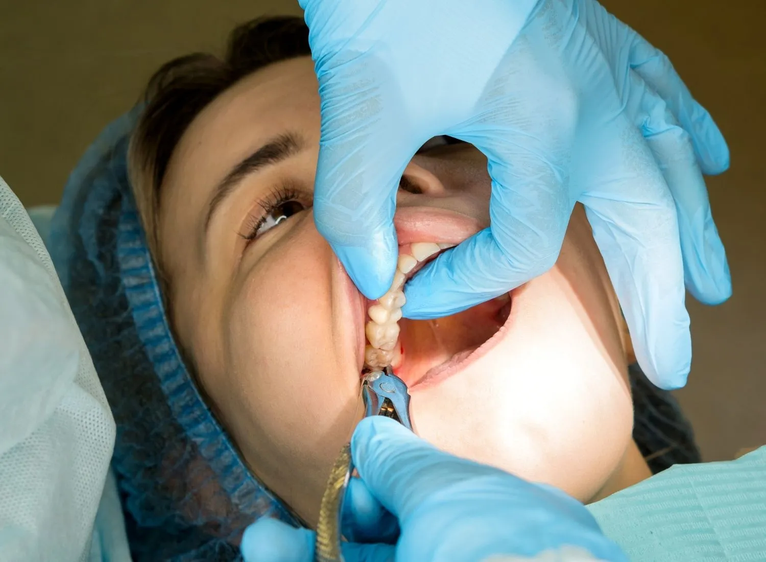 Dental professional wearing blue gloves extracts a tooth from a patient's mouth with pliers.