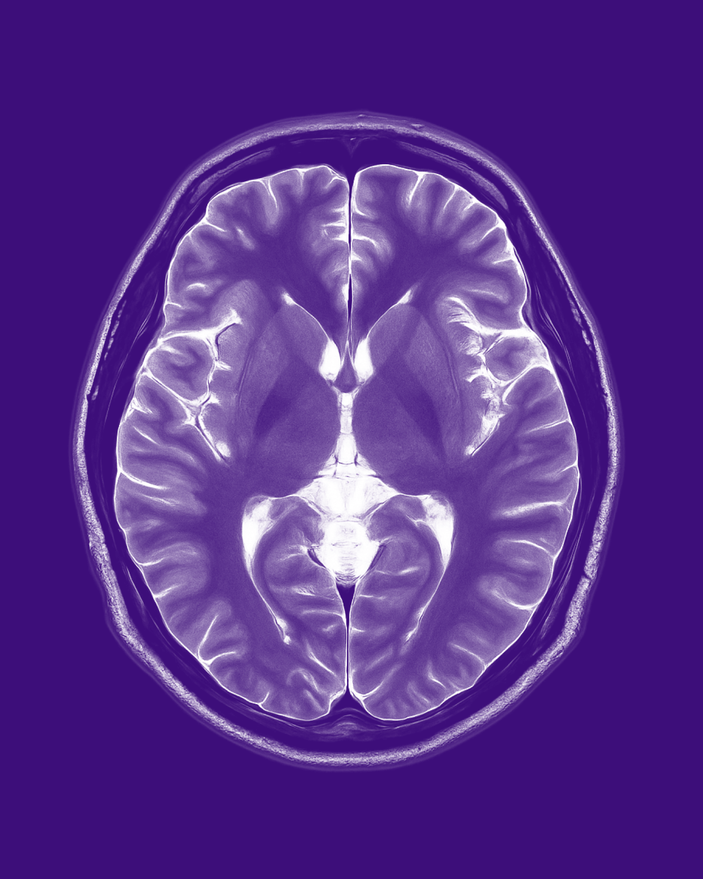 MRI scan of a human brain in purple tones, showing symmetrical structures.