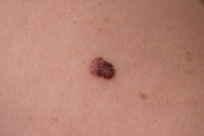 Atypical Moles