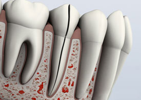 Split tooth