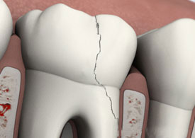 Fractured cusp