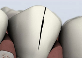 Treatable cracked tooth