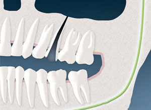Opening to sinus