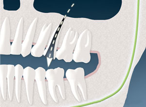 Air communication from sinus