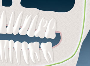 Sinus communication corrected