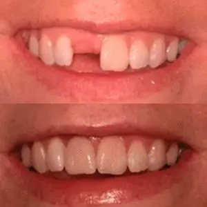 Before and after photos showing dental restoration on upper front teeth with improved alignment.