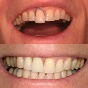 Before and after photos of a person's upper teeth showing gap closure and dental improvement.