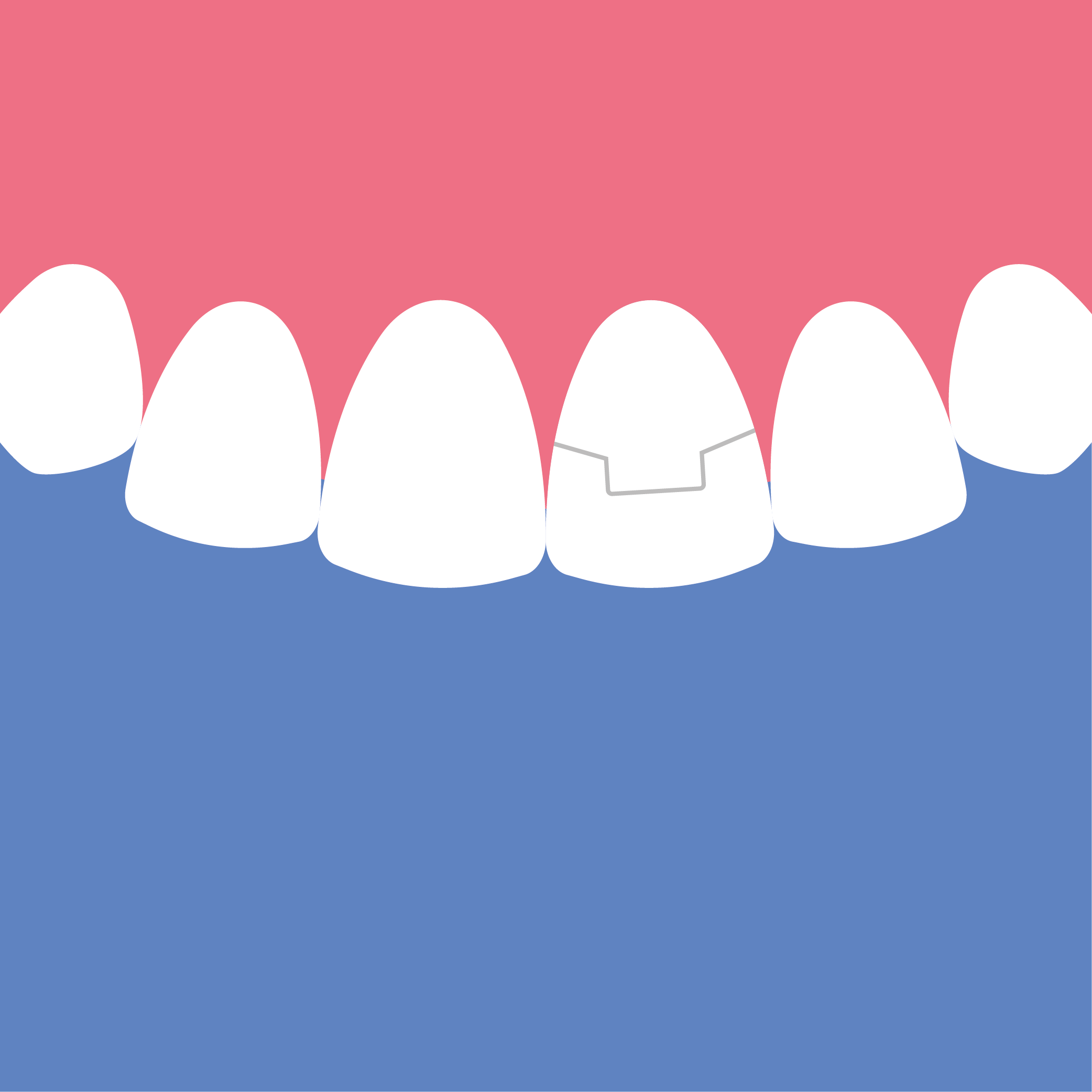 Illustration eines oberen Schneidezahns mit Implantat