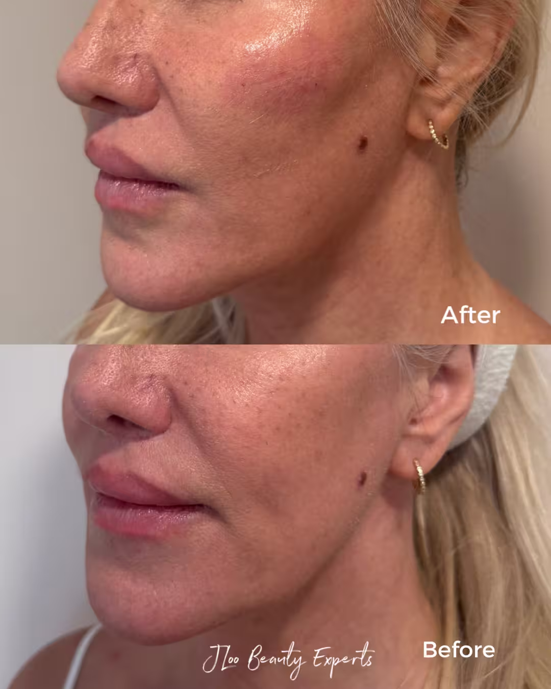 Dermal filler before and after results at JLoo Beauty Experts NYC