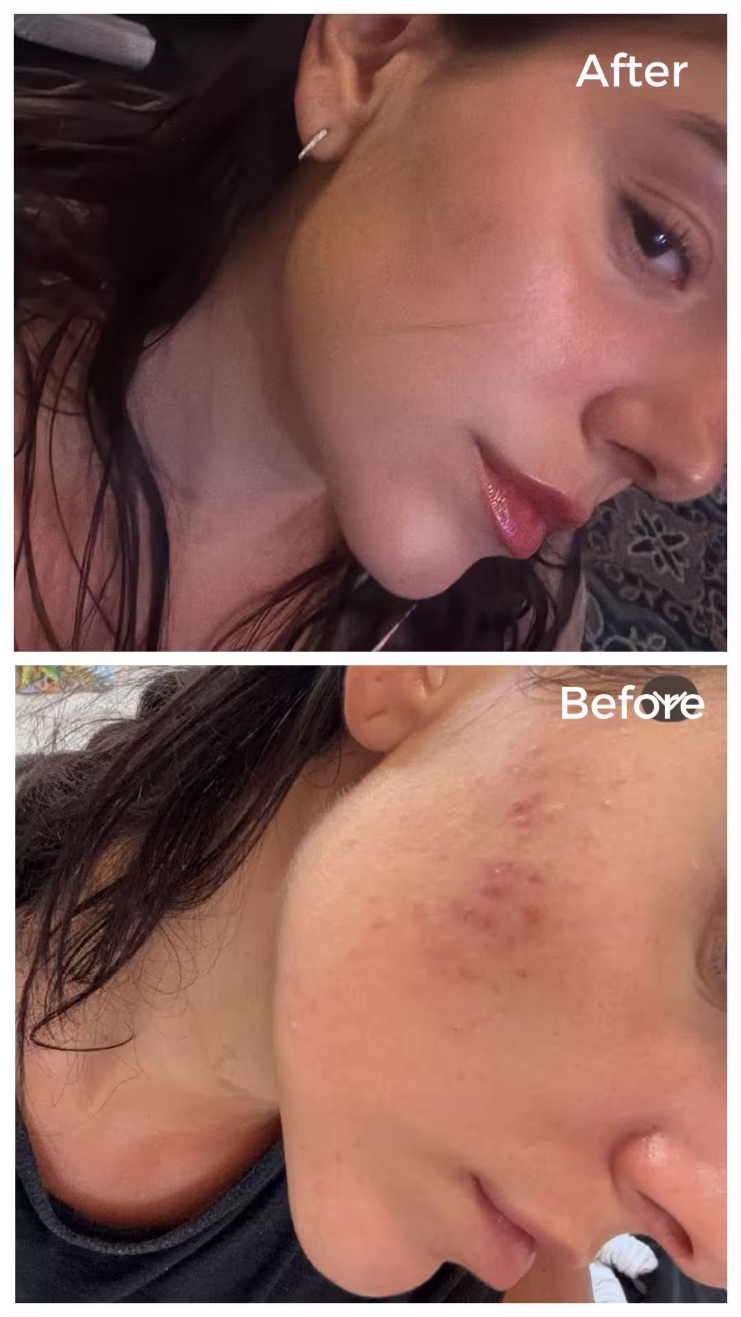 Chemical peel before and after — JLoo Signature Peel, Midtown NYC